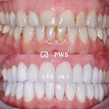 Perfect White Smile - Custom-made veneers by Dr. Frey DDS. - Cosmetic Dentists Near Me - Beverly Hills, California Perfect White Smile - Custom-made veneers by Dr. Frey DDS. - Cosmetic Dentists Near Me - Beverly Hills, California