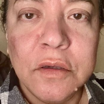 Clara Medical Spa - before my vampire facial and Michael Gator Before my vampire facial and micro needling - Medical Spas Near Me - Santa Clara, California Clara Medical Spa - before my vampire facial and Michael Gator Before my vampire facial and micro needling - Medical Spas Near Me - Santa Clara, California