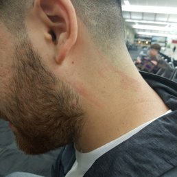 The person cutting my hair scratch me pretty hard with the hair cutting machine on both sides of my neck. The person cutting my hair scratch me pretty hard with the hair cutting machine on both sides of my neck.