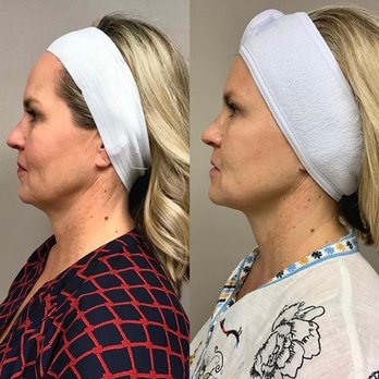 Modern Skin Solutions - Before and after 6 Accent Skin Tightening Laser on neck - Skin Care Near Me - League City, Texas Modern Skin Solutions - Before and after 6 Accent Skin Tightening Laser on neck - Skin Care Near Me - League City, Texas
