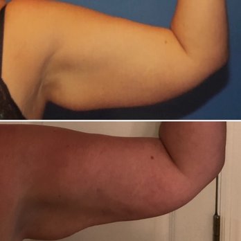 Joshua A. Halpern, M.D. P.A - Before (top) After (bottom) - Cosmetic Surgeons Near Me - Tampa, Florida