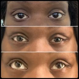 Before and after canthoplasty & lower eyelid retraction surgery