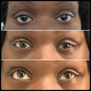 Oculofacial Surgical Arts - Before and after canthoplasty & lower eyelid retraction surgery - Plastic Surgeons Near Me - Del Mar, California