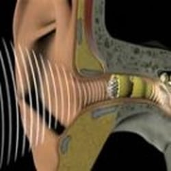 Advanced Audiology Institute - The only extended wear invisible hearing aid. Advanced Audiology Institute is the only Lyric Premier Provider in Las Vegas.