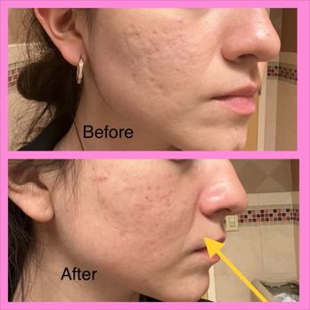 Scar Healing Institute - Skin is no longer tightly bound to the base of my face. With every facial expression I feel constant stiffness. - Dermatologists Near Me - Beverly Hills, California Scar Healing Institute - Skin is no longer tightly bound to the base of my face. With every facial expression I feel constant stiffness. - Dermatologists Near Me - Beverly Hills, California