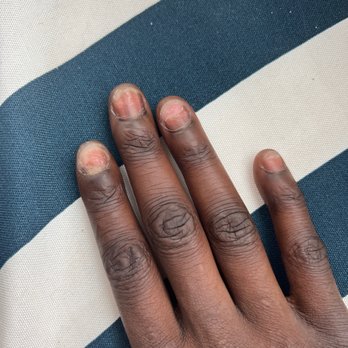 Sassy Nails and Tanning - Here are my nails after removal of acrylic tips. Fungus and damaged nails from this disgusting salon! - Nail Salons Near Me - Ellsworth, Maine