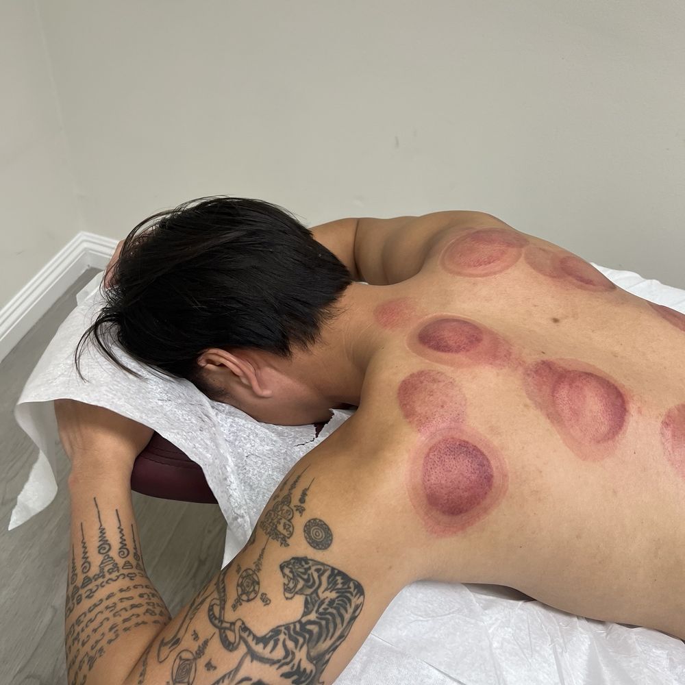 Chosen Acupuncture - Cupping - Acupuncture Near Me - Rosemead, California Chosen Acupuncture - Cupping - Acupuncture Near Me - Rosemead, California