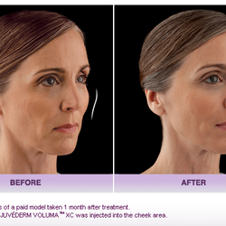 Daniel Behroozan, MD, FAAD, FACMS - FDA Approved, Voluma is an injectable facial filler. It temporarily restores volume to the mid-face