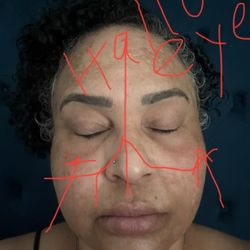 Truesdale Facial Plastic Surgery - Crinkled neck after deep plane face lifts Hollow eyes after upper and lower eye lift