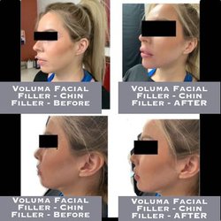 Sandia Skin + Face - Voluma Facial Filler - Chin Filler - Before-After
