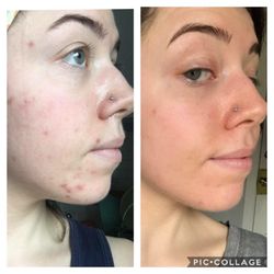 Denver Healthy Skin & Acne Clinic