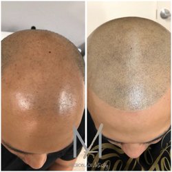 Microblade Artistry - Scalp Micropigmentation instantly restores hairlines & bald areas.  Freshly done, scalp looks amazing & will heal even more natural!