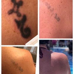St Pete Tattoo Removal - Client outcome after treatment with the Trinity Laser System