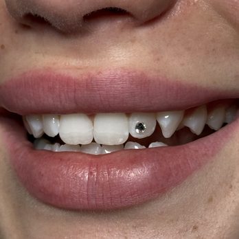 Cute Tooth - After 1 hr teeth whitening plus a gem! - Teeth Whitening Near Me - San Diego, California