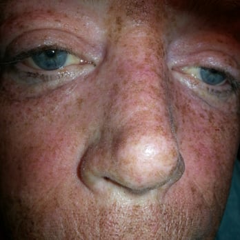Physicians Laser Aesthetics & Cosmetics - 1st day after lazer..all my freckles were there..now on day 6 there gone.. - Cosmetics & Beauty Supply Near Me - Rocklin, California Physicians Laser Aesthetics & Cosmetics - 1st day after lazer..all my freckles were there..now on day 6 there gone.. - Cosmetics & Beauty Supply Near Me - Rocklin, California