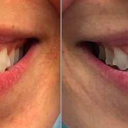 Daniel A Kaplan, DDS, PC - "Gummy Smile "before and after Gingivectomy