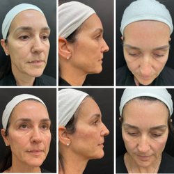 Serenity MD Weight Loss & Medical Spa - Cheek/Temples/Chin augmentation with Juvederm Voluma, Volbella and Vollure.