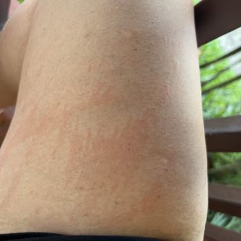 Mysa Day Spa - Welts on day four after being waxed - Day Spas Near Me - San Francisco, California