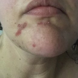 Burns from wax Burns from wax