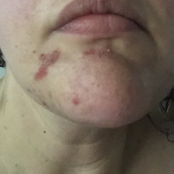 Mila Threading & Beauty Salon - Burns from wax - Eyelash Service Near Me - Columbus, Ohio Mila Threading & Beauty Salon - Burns from wax - Eyelash Service Near Me - Columbus, Ohio