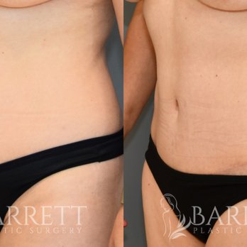 Alex Neusner, MD - Tummy tuck before & after at 4 months post-op, showing a flatter abdomen and more defined, balanced contour. - Plastic Surgeons Near Me - Beverly Hills, California Alex Neusner, MD - Tummy tuck before & after at 4 months post-op, showing a flatter abdomen and more defined, balanced contour. - Plastic Surgeons Near Me - Beverly Hills, California