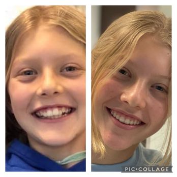 Beverly Hills Orthodontics - Before and After - Orthodontists Near Me - Los Angeles, California Beverly Hills Orthodontics - Before and After - Orthodontists Near Me - Los Angeles, California