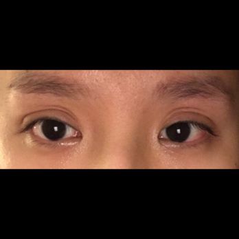 Aesthetic KS - 4.5 months post-op,still have a lot swelling. Ugly shapes - Cosmetic Surgeons Near Me - Los Angeles, California Aesthetic KS - 4.5 months post-op,still have a lot swelling. Ugly shapes - Cosmetic Surgeons Near Me - Los Angeles, California