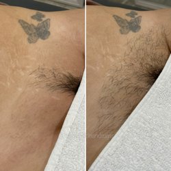 The La Mirada Esthetician - Landing strip bikini Brazilian sugaring.