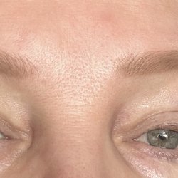 J. Sweat Plastic Surgery - Photo of my eyelids surgery