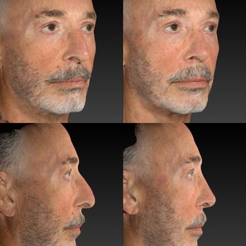 Stepanyan Surgical Arts Center - Rhinoplasty Before and After.
Performed by Dr. Martin Stepanyan - Cosmetic Surgeons Near Me - Glendale, California Stepanyan Surgical Arts Center - Rhinoplasty Before and After.
Performed by Dr. Martin Stepanyan - Cosmetic Surgeons Near Me - Glendale, California