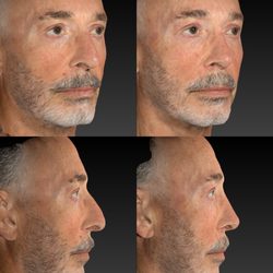Stepanyan Surgical Arts Center - Rhinoplasty Before and After. 

Performed by Dr. Martin Stepanyan