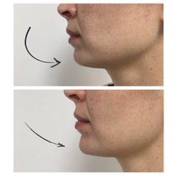 Express Cosmetic Laser Med Spa - Before and After Chin Augmentation using Juvederm Ultra Plus XC
