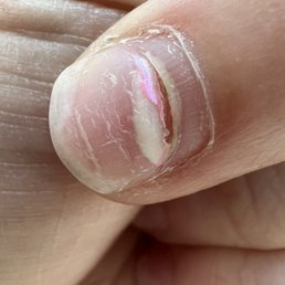 After the acrylic came off After the acrylic came off