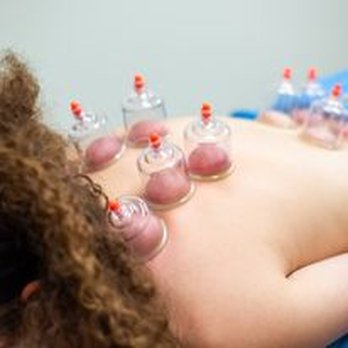 BodyWorks Chiropractic - Cupping helps alleviate chronic muscle tension - Chiropractors Near Me - Euless, Texas BodyWorks Chiropractic - Cupping helps alleviate chronic muscle tension - Chiropractors Near Me - Euless, Texas