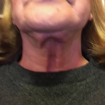 Steven H Dayan, MD, FACS - Front neck view. Note the jowls above that were to be corrected by the "mini-face lift". - Cosmetic Surgeons Near Me - Chicago, Illinois Steven H Dayan, MD, FACS - Front neck view. Note the jowls above that were to be corrected by the "mini-face lift". - Cosmetic Surgeons Near Me - Chicago, Illinois