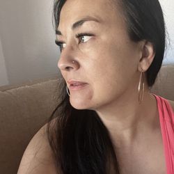 Evergreen Wellness Clinic - 2 weeks post Botox