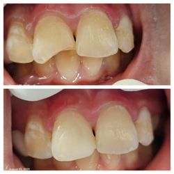 Kanoknuch S. Shiflett, DDS - Fractured tooth? We can help!