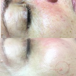 Rochell Overn Esthetics - Nanoinfusion eye and lip treatment with signature facial produces immediate results in just one treatment!