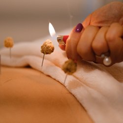 Panacea Acupuncture Center - Moxibustion
