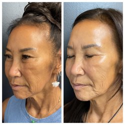 LEO Aesthetics - SkinCeuticals TCA Peel - 2 Treatments.