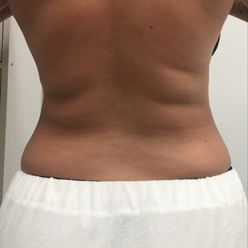 Leconte Beauty - After a couple of sessions - Body Contouring Near Me - Astoria, New York Leconte Beauty - After a couple of sessions - Body Contouring Near Me - Astoria, New York