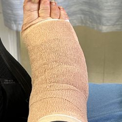 Romina Vincenti, DPM - Airport Podiatry Group - Waking up from surgery, wrapped!