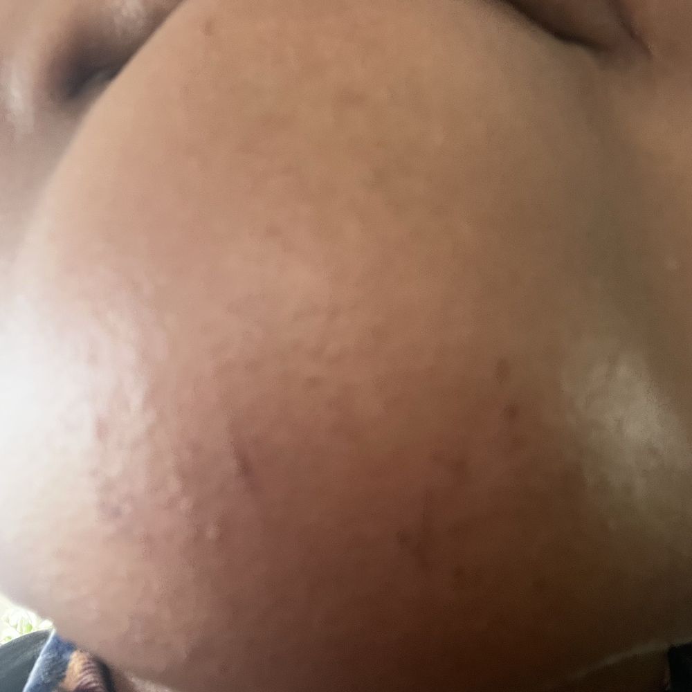Nipa Eyebrow Threading - Scarring from threading on my chin - Threading Services Near Me - Jamaica, New York Nipa Eyebrow Threading - Scarring from threading on my chin - Threading Services Near Me - Jamaica, New York