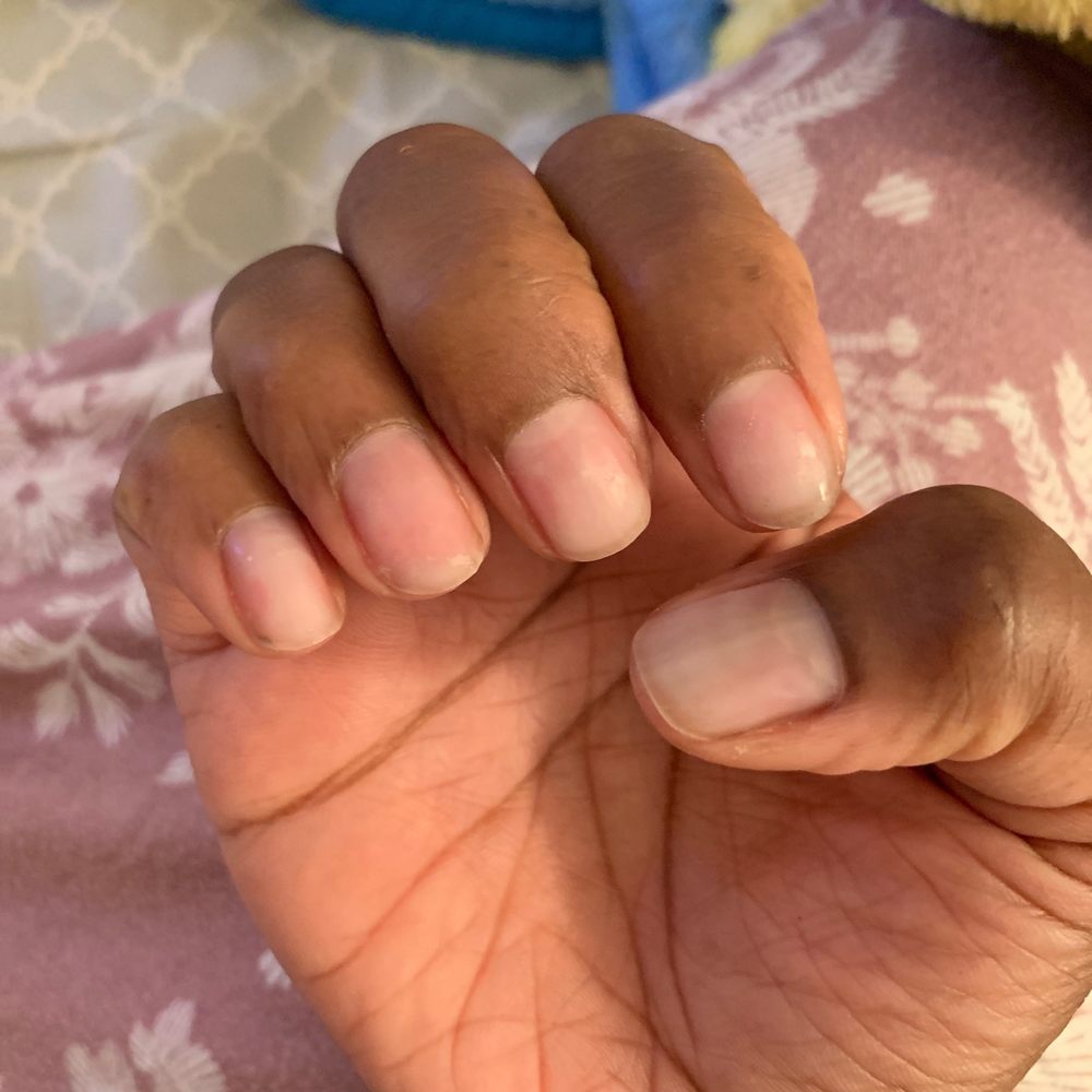 Japan beauty plus - Other hand. Anything that touches my finger nails hurts. - Skin Care Near Me - Diamond bar, California Japan beauty plus - Other hand. Anything that touches my finger nails hurts. - Skin Care Near Me - Diamond bar, California