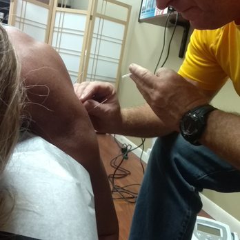 Michael A Selvitella, DC - Inserting the needles for the electrical acupuncture - Chiropractors Near Me - Streamwood, Illinois