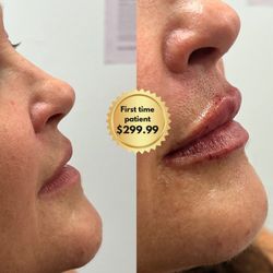 Aterna Wellness - Get the lips you've always wanted! Lip Filler in Fontana, CA just $299.99 at Aterna Wellness. Book now!