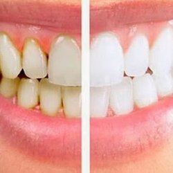 Connexions Dental Hygiene - Take if OFF! Masks mouth is real and we can help!