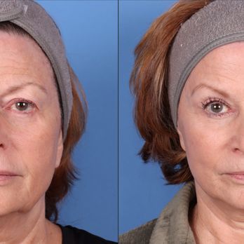 Guy Cappuccino, MD - Blepharoplasty results - Plastic Surgeons Near Me - Mount Airy, Maryland Guy Cappuccino, MD - Blepharoplasty results - Plastic Surgeons Near Me - Mount Airy, Maryland