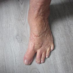 John E. Baker, DPM - this is how i look AFTER the bunionectomy!