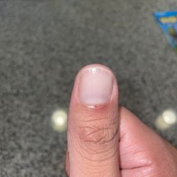 Cut up thumb Cut up thumb